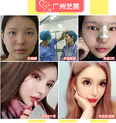 广州李闯鼻子怎么样？半肋骨隆鼻大概多少钱？