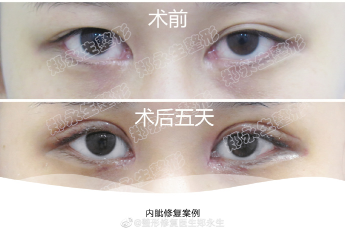 北京郑永生修复内眼角怎么样