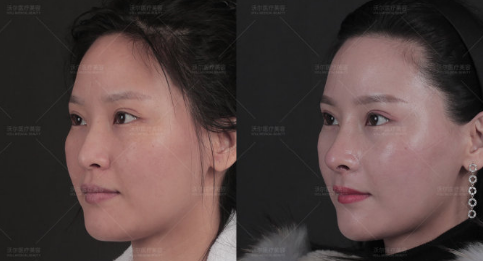北京隆鼻做得好的医生是哪个