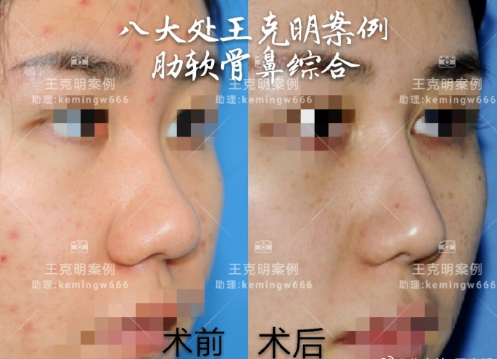 北京八大处谁做鼻子最自然
