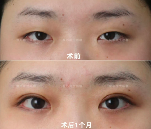 武汉杨蓉做双眼皮技术怎么样？武汉双眼皮医生杨蓉技术好吗？