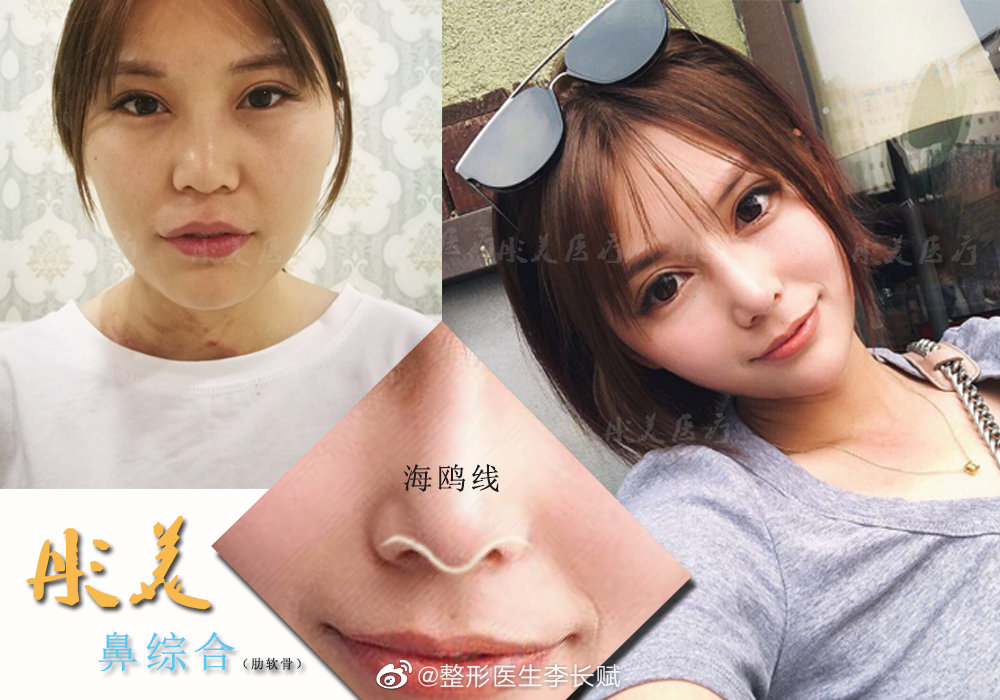 国内鼻综合做得好的专家
