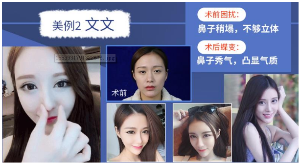 广州做鼻子最好的整形医生是谁呀？大概需要多少钱？