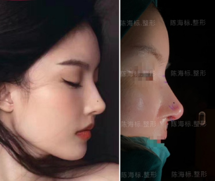 上海陈海标肋骨鼻怎么样