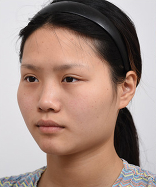 北京美憬医院李炳浍做鼻子技术反馈怎么样？