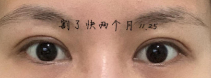 上海何祥龙割双眼皮怎么样