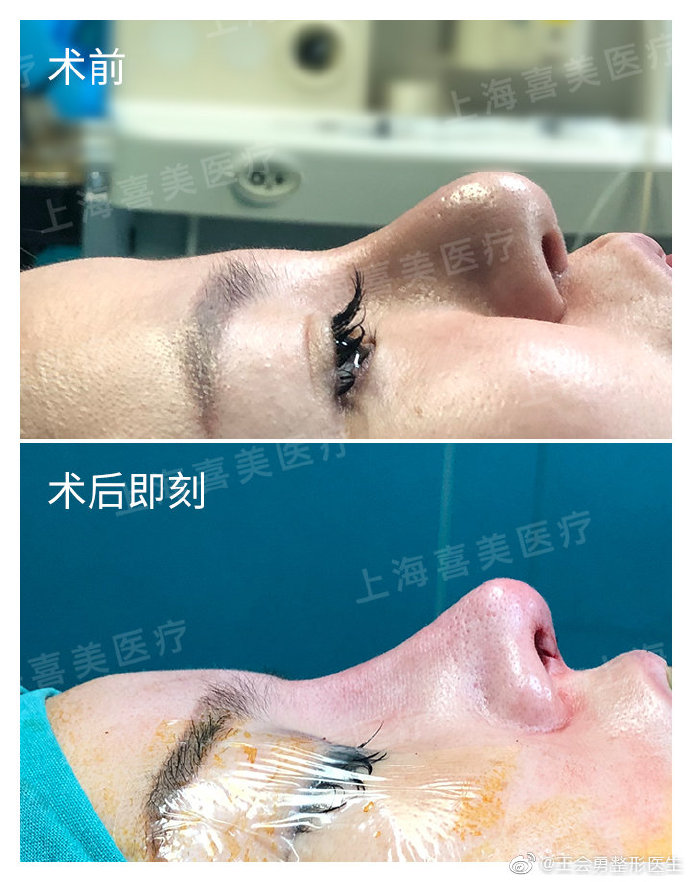 北京和上海隆鼻专家都有哪些？李占强PK刘彦军哪个做隆鼻最好？
