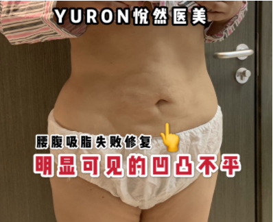 北京任学会和李京霖谁脂肪修复做的好？