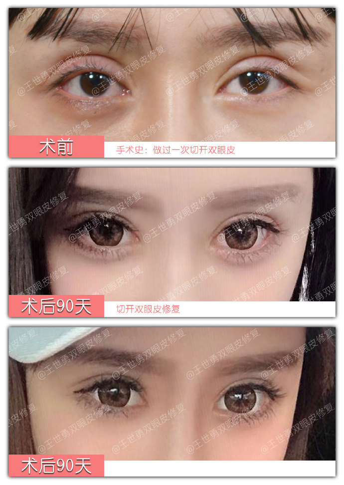 北京双眼皮修复王世勇和靳小雷谁厉害？