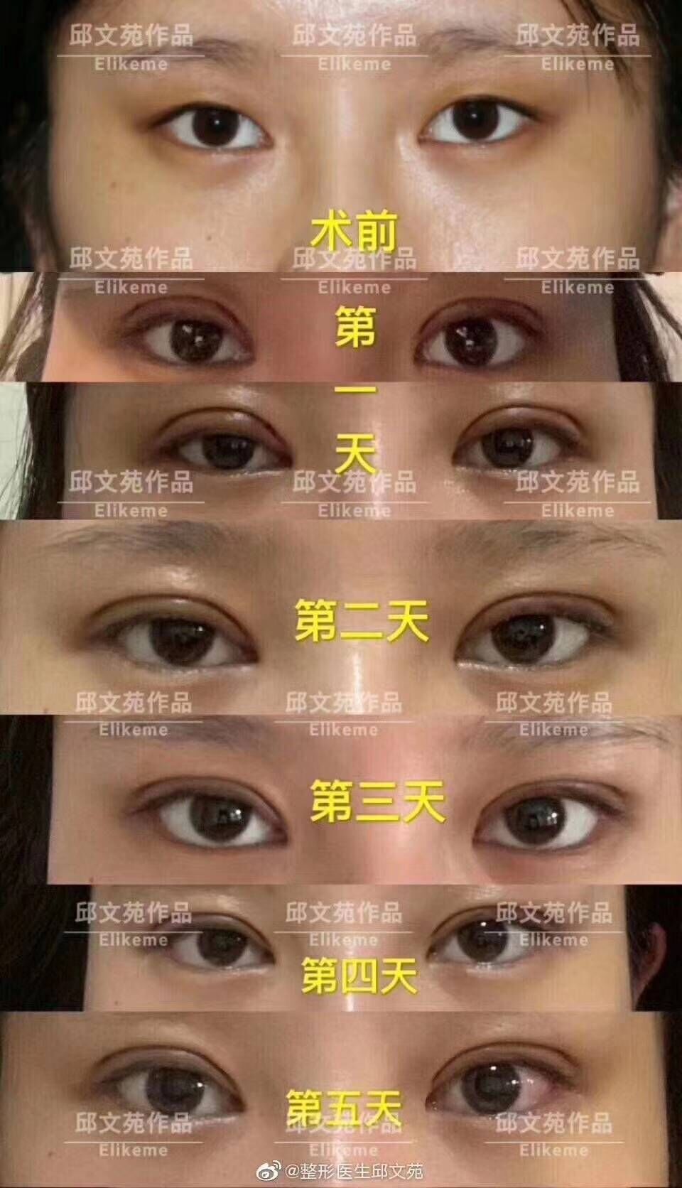 上海邱文苑和朱迪做眼综合谁好