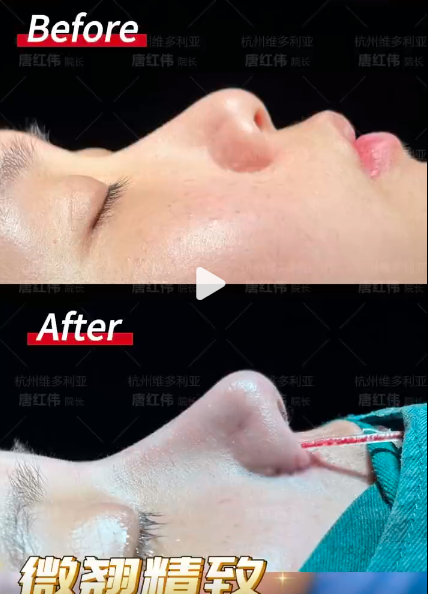 杭州唐红伟做鼻子技术怎么样？唐红伟隆鼻怎么预约？