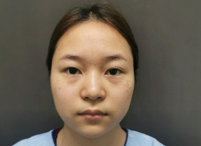 北京赵宏伟做眼综合怎么样