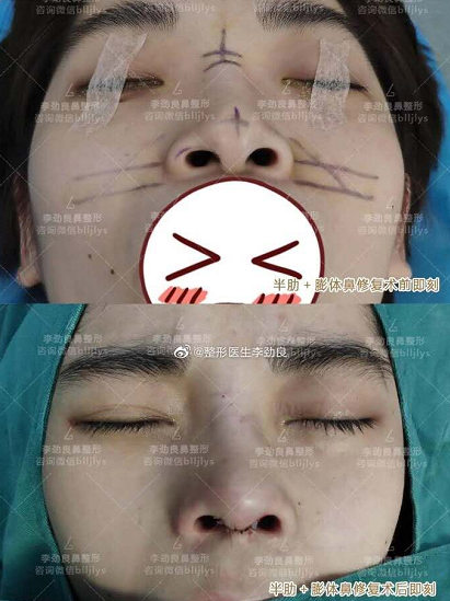 中国哪个医生取鼻子假体最厉害