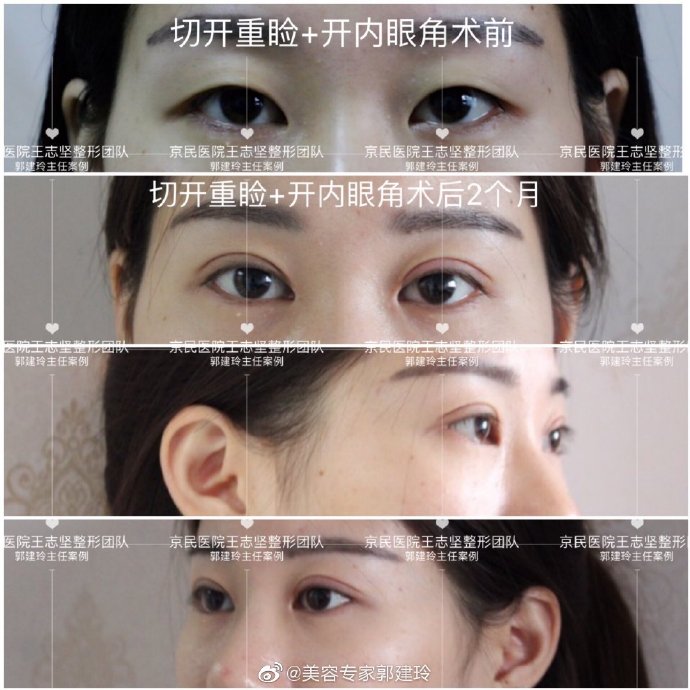 北京眼综合最好的医生是谁？哪个医生审美好？