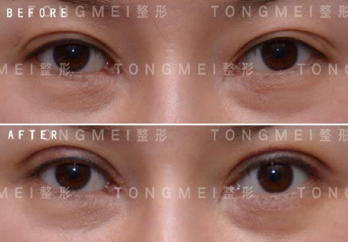双眼皮修复刘风卓和王世勇哪个好
