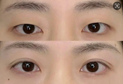 深圳擅长做双眼皮的医生有哪些？周敏、吕瑛、姜灿、王欢、向萌娟谁好？