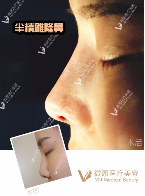 滕召勇_达拉斯综合鼻整形中南地区推广人
