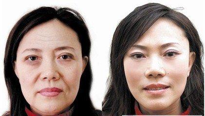上海九院做面部提升哪个做得好