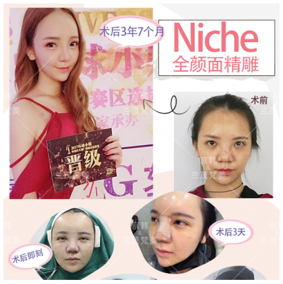 北京京韩乔爱军做面部精雕效果到底好不好？
