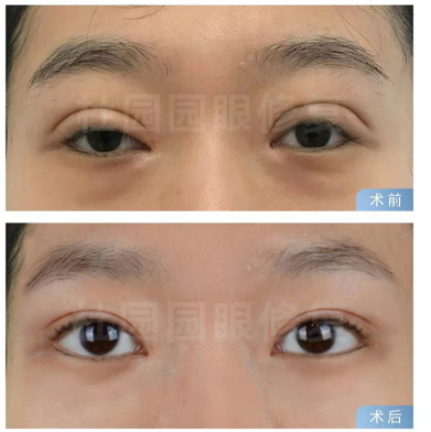 2025年上海眼修复和双眼皮修复哪位医生最好？上海眼修复专家排行榜大全