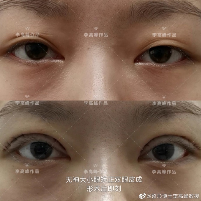 湖南省人民医院李高峰做双眼皮好看吗？