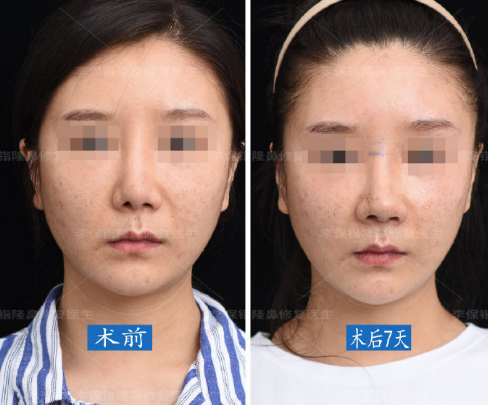 杭州李保锴做鼻子怎么样