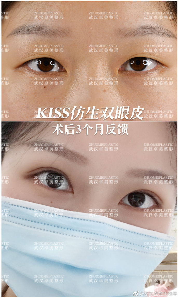 武汉做双眼皮王海平和吴小蔚哪个好