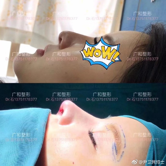 深圳鼻修复尹卫民和朱灿谁做得好