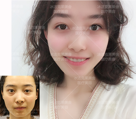 张冰洁和王振军哪个做双眼皮修复好？