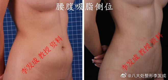 北京八大处李发成吸脂如何
