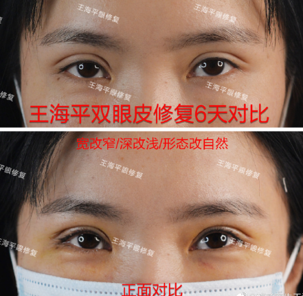 武汉做双眼皮修复最好的医生