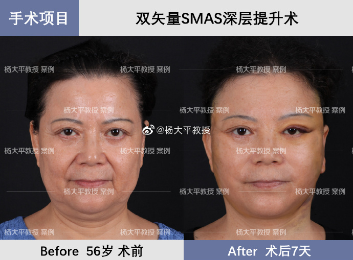 北京杨大平和孙玮骏谁的面部提升更好？