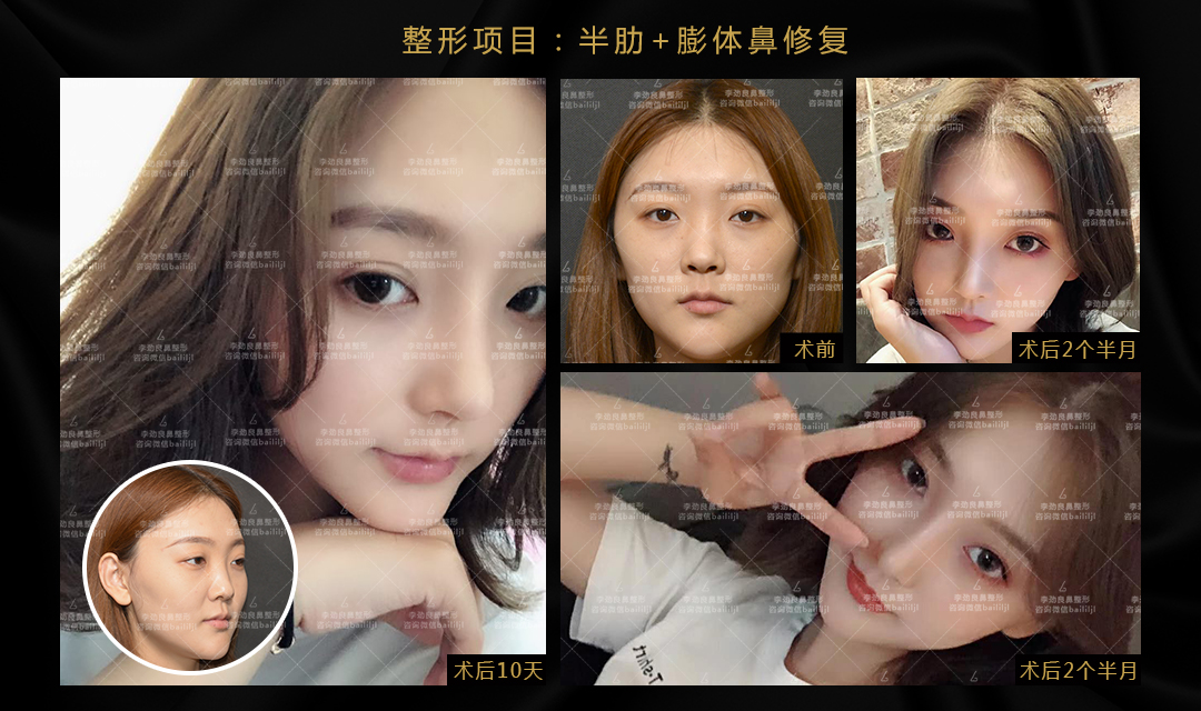 北京鼻子整形最好的医院有哪些？