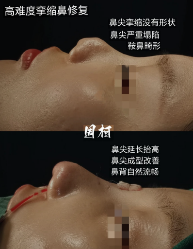 国内擅长做挛缩鼻的专家有哪些？：曲妙轩、巫文云、李长富、周仪、刘波谁好？