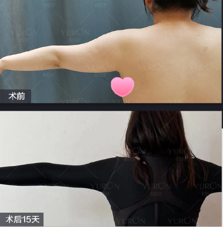李京霖吸脂怎么样，技术好吗