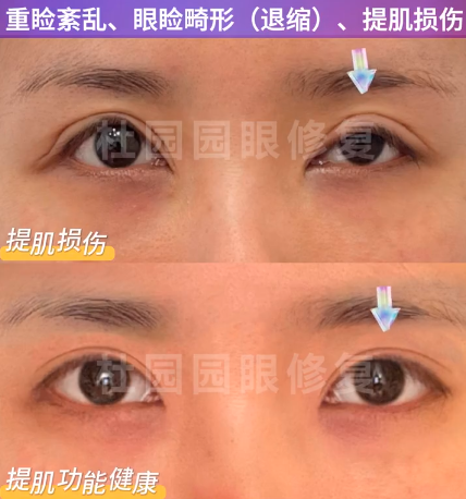 上海眼修复医生郑小红、张楚、杜园园哪个好？2025年上海最好的眼修复医生排名