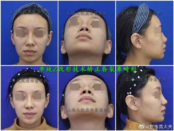 上海隆鼻最顶级专家是谁？