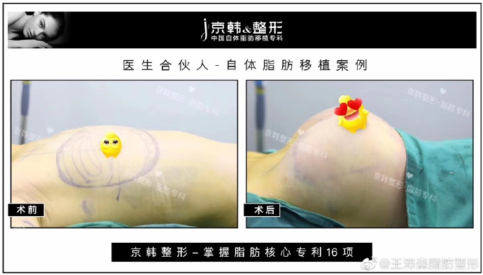 北京脂肪丰胸王沛森和王明利哪个好？