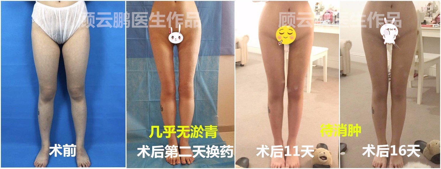 北京八大处顾云鹏吸脂多少钱？