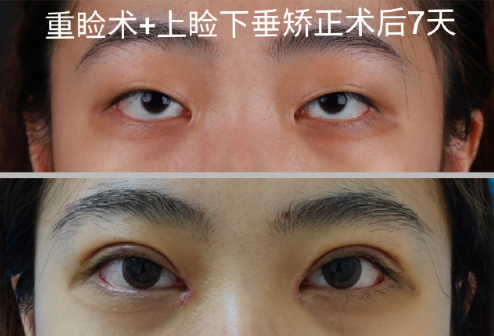 2025年深圳双眼皮做得好的医生是哪个？向萌娟、吕方中、秦菲菲、张双耀？