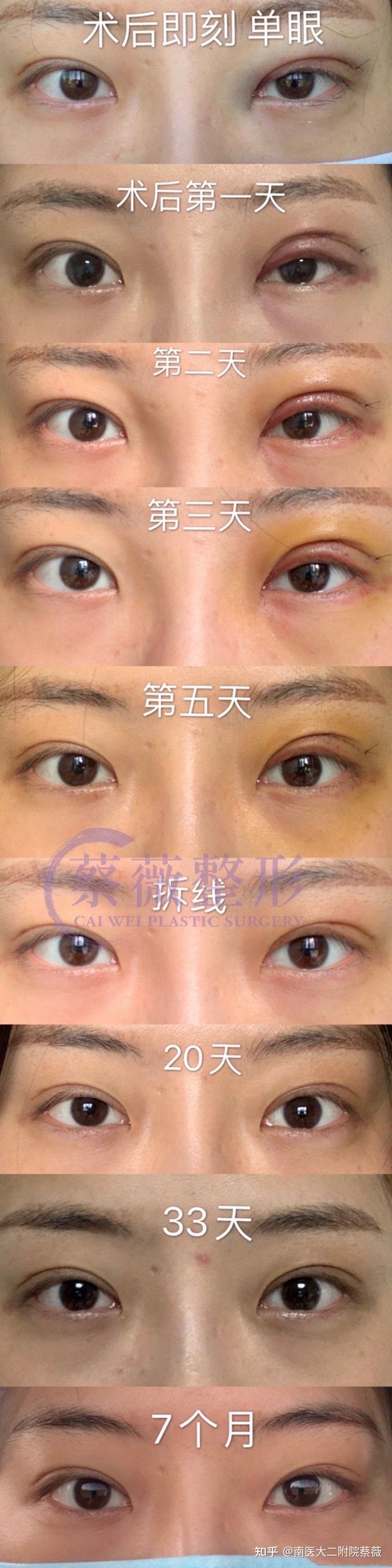 南京蔡薇双眼皮做得怎么样