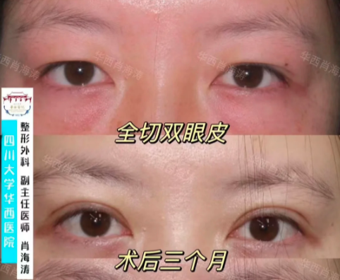 成都华西医院肖海涛割双眼皮怎么样？肖海涛做双眼皮技术好不好？