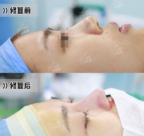 广州鼻综合罗延平和王世虎哪个好？