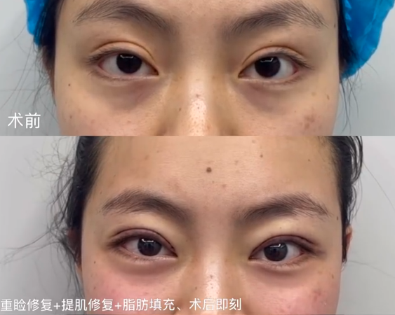 成都双眼皮修复厉害的医生有哪些？肖海涛、陈杨、杨迪、陈建华、林靖眼修复谁好？