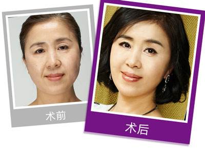 上海九院李青锋和张余光做面部提升哪位好？