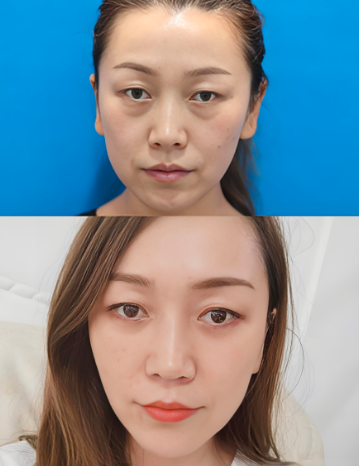 2025年北京祛眼袋最好的医生是谁？宋春琼、于燕、王千文、郭时伟、刘玲谁好？