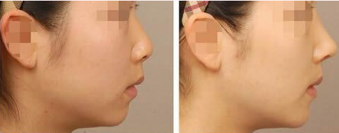 牛永敢_美莱集团首席鼻整形技术指导专家