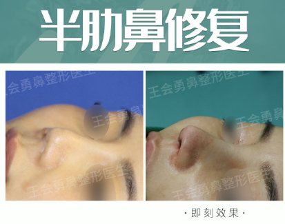 上海王会勇隆鼻修复多少钱
