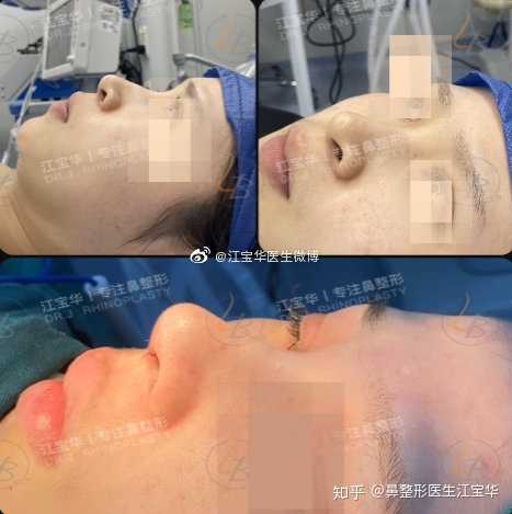 上海江宝华和王会勇谁做鼻子好