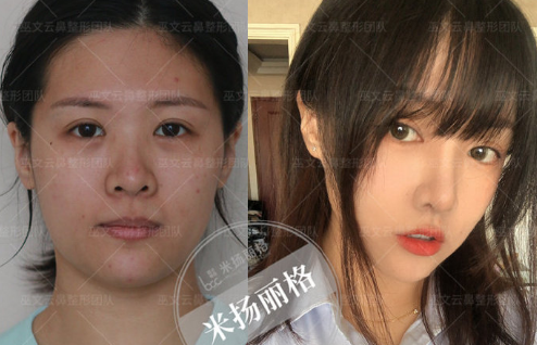 北京巫文云和李劲良谁做鼻子好